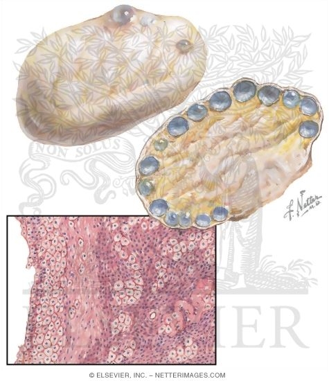 Polycystic Ovarian Disease