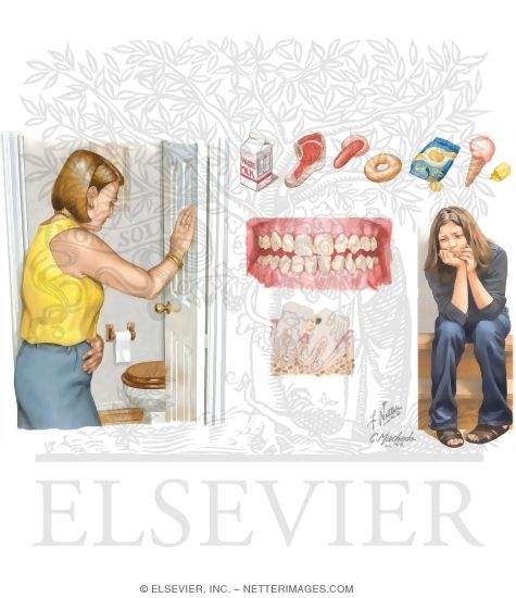 Watermarked preview of unlabeled image: Signs and Symptoms of Bulimia Nervosa
