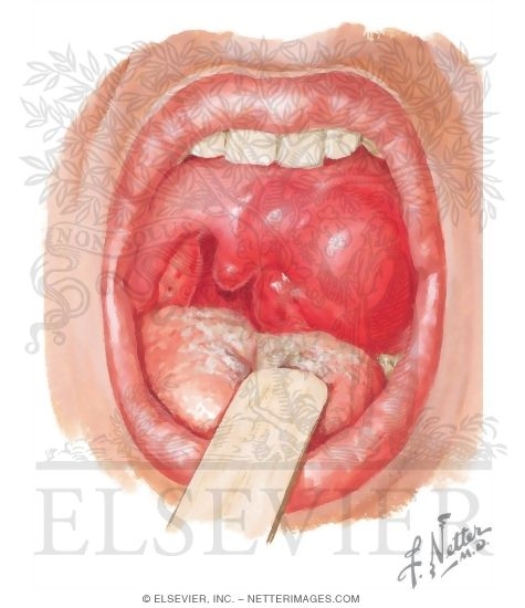 Peritonsillar Abscess (Quinsy)