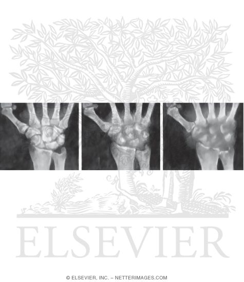 Septic Arthritis:  Imaging