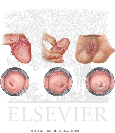 Genital Warts