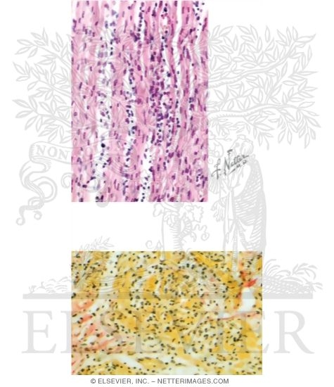 Viral Myocarditis