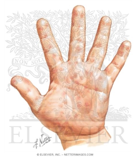 Hand, Foot, and Mouth Disease (HFM)