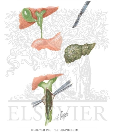 Watermarked preview of unlabeled image: Biliary Atresia and Cholestasis