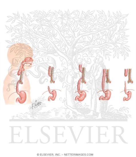 Tracheoesophageal Fistula