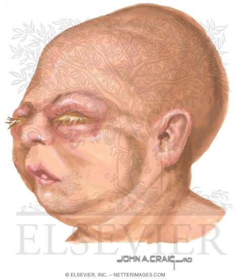 Gonococcal Ophthalmia