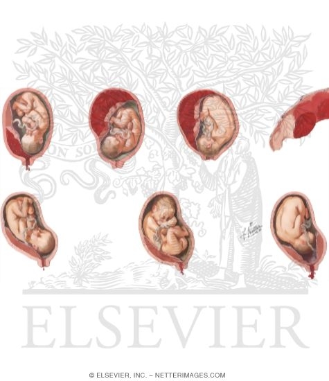 Placental Abruption and Previa