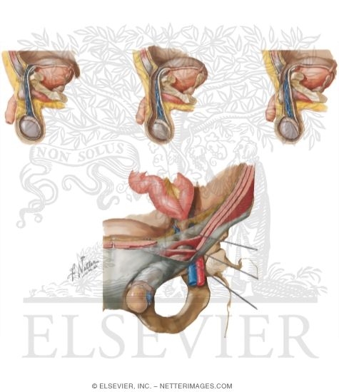 Watermarked preview of unlabeled image: Indirect Inguinal Hernia