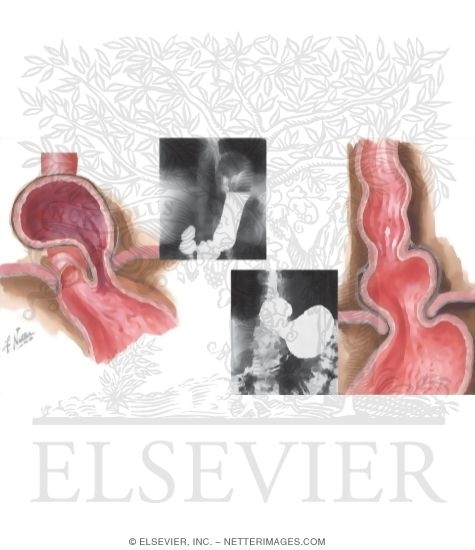 Hiatal Hernias