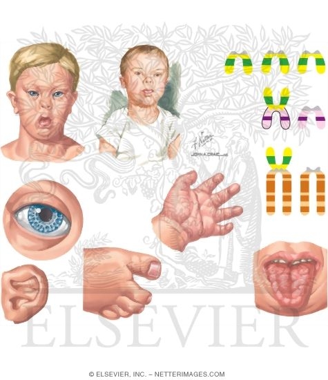 Trisomy 21 (Down Syndrome)