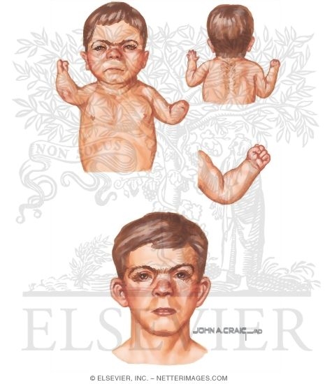 Profile of the Face In a Patient With Cornelia de Lange Syndrome