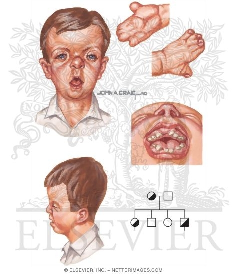 Apert Syndrome