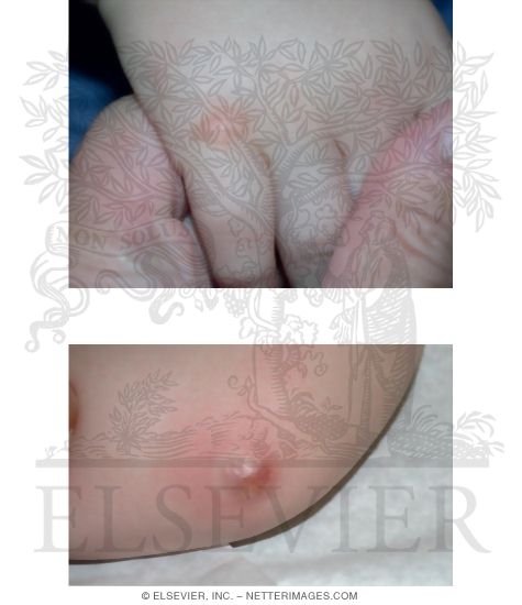 Mastocytosis
