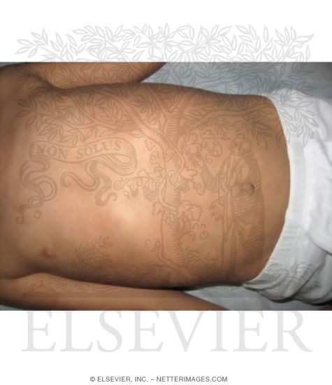 Post Inflammatory Hyperpigmentation