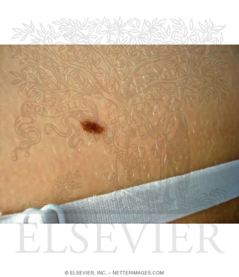 Common Nevus