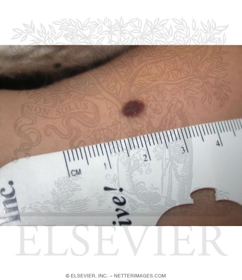 Dysplastic Nevus