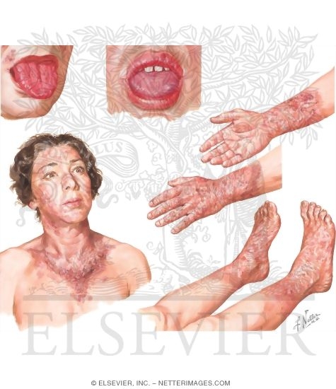 Niacin Deficiency (Pellagra)