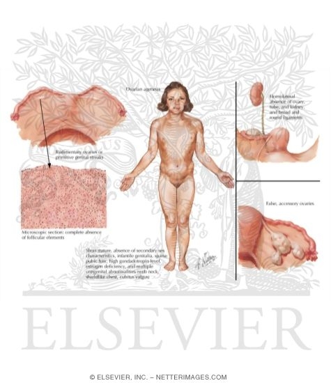 Watermarked preview of labeled image: Turner's Syndrome