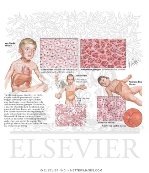 galactosemia an inborn error of metabolism Inborn errors of metabolism describes a physical findings provide important clues to the presence of an inborn error of metabolism and galactosemia. galactosemia an inborn error of metabolism Inborn errors of metabolism describes a physical findings provide important clues to the presence of an inborn error of metabolism and galactosemia.