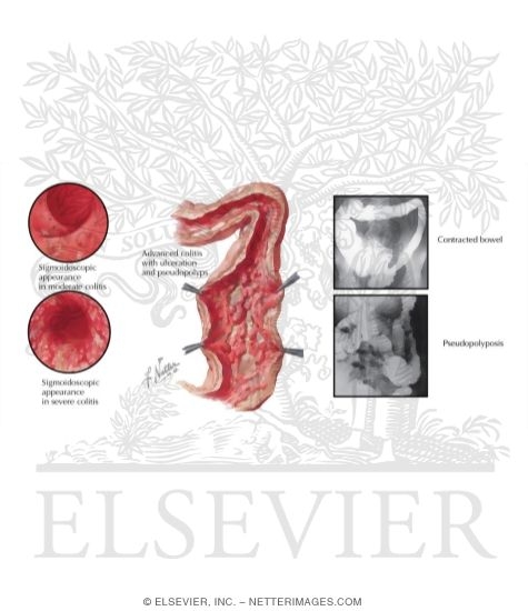 Watermarked preview of labeled image: Ulcerative Colitis
