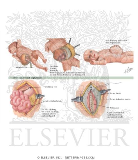 Omphalocele