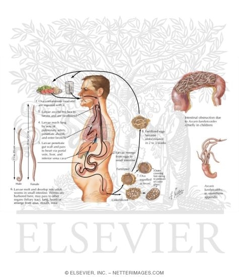Watermarked preview of labeled image: Parasitic Diseases II - Ascariasis