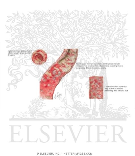 Bacillary Dysentery
