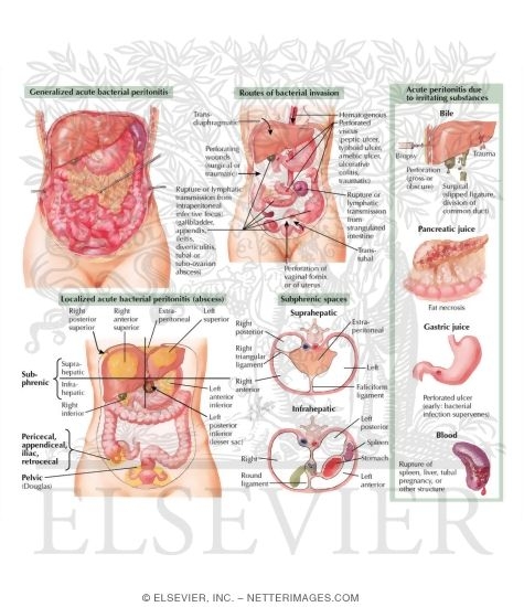 Watermarked preview of labeled image: Acute Peritonitis