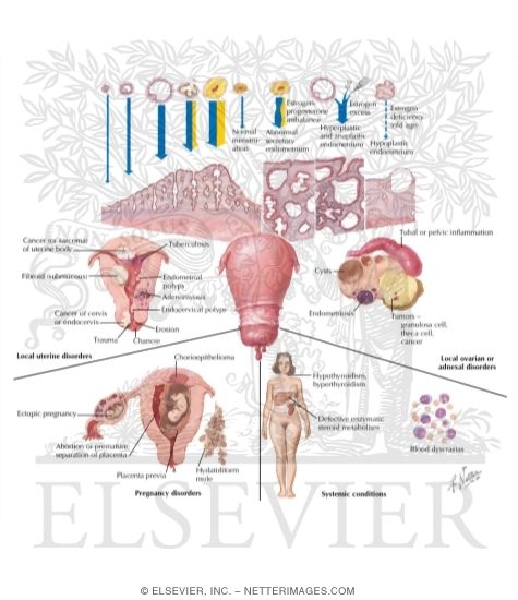 Watermarked preview of labeled image: Functional and Pathological Causes of Uterine Bleeding
Dysfunctional Uterine Bleeding