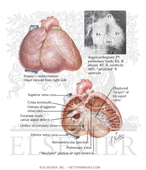 Watermarked preview of labeled image: Anomalies of the Tricuspid Valve
Ebstein's Malformation