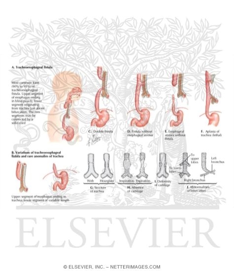Tracheoesophageal Fistula
