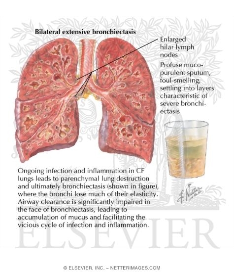 Watermarked preview of labeled image: Bronchiectasis