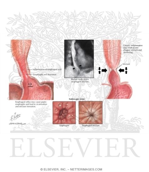 Watermarked preview of labeled image: Gastroesophageal Reflux Disease