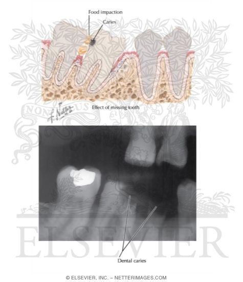 Watermarked preview of labeled image: Dental Caries