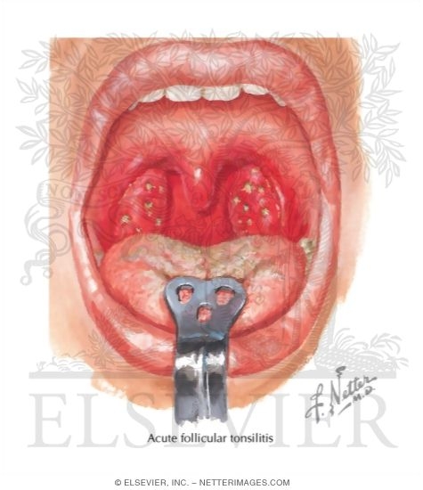 Watermarked preview of labeled image: Tonsillitis