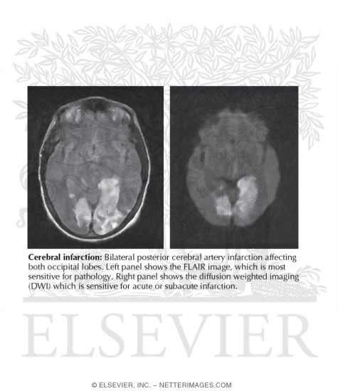 Watermarked preview of labeled image: Diagnostic Tests for Infarction