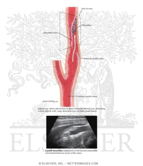 Arterial Dissection