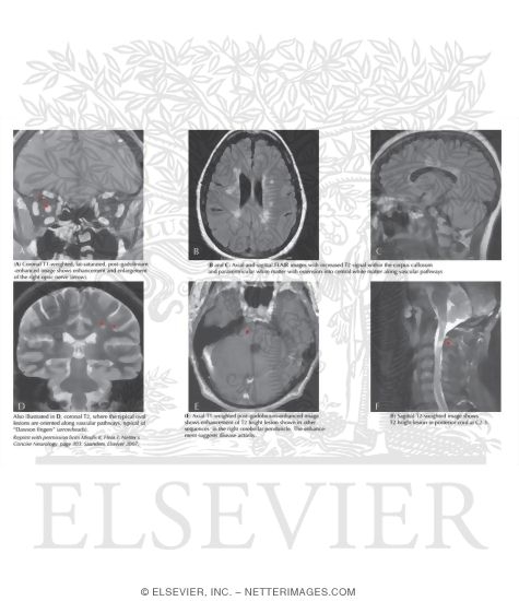 Watermarked preview of labeled image: Multiple Sclerosis