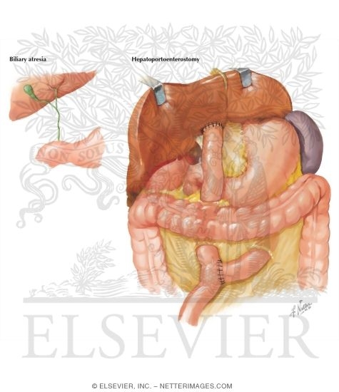 Watermarked preview of labeled image: Biliary Atresia