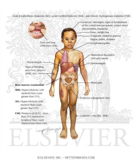 Clinical Presentation of Leukemia
