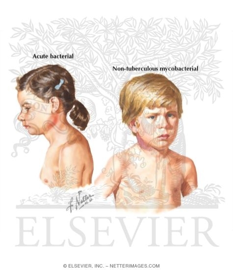 Watermarked preview of labeled image: Cervical Lymphadenitis