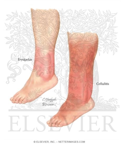 Appearance of Erysipleas and Cellulitis