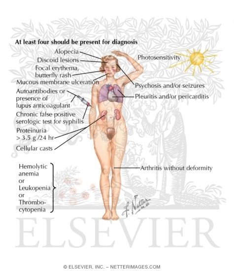 Watermarked preview of labeled image: Criteria Used for Diagnosis of Systemic Lupus Erythematosus