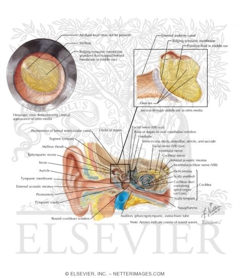 Acute Otitis Media