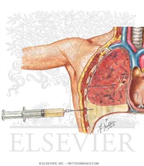 Pleural Fluid Aspiration