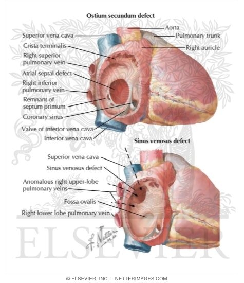 Watermarked preview of labeled image: Defects of the Atrial Septum