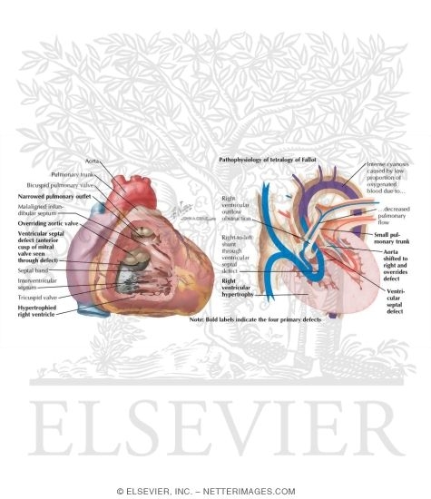Watermarked preview of labeled image: Tetralogy of Fallot
