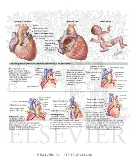 Tricuspid Atresia