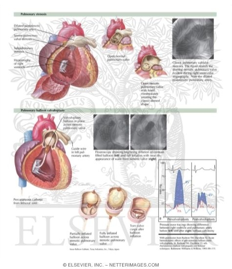 Watermarked preview of labeled image: Critical Pulmonic Stenosis