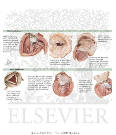 Watermarked preview of labeled image: Rheumatic Heart Disease: Clinical Presentation